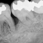 歯周病治療　再生治療